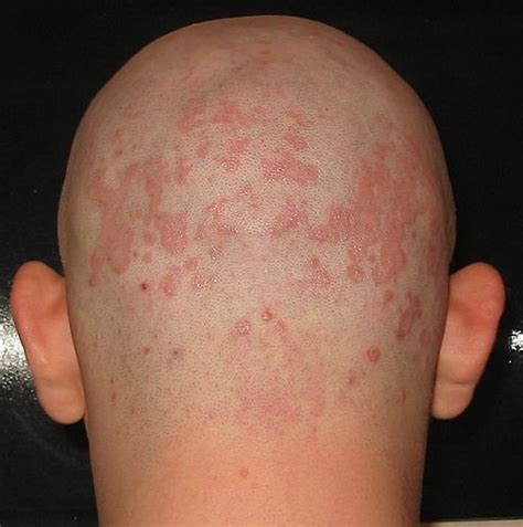 Does Seborrheic Dermatitis Cause Hair Loss?
