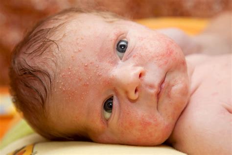 Tratamiento del acné neonatal - Eres Mamá Enfermedades en el bebé