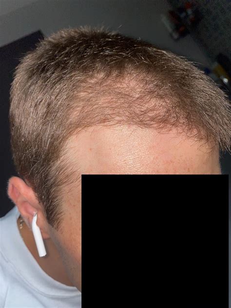 Dr. Kaan Pekiner - 3,009 Grafts FUE 2/25/22 - Page 2 - Hair Transplant ...