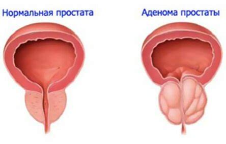 Частое мочеиспускание у мужчин: причины, лечение