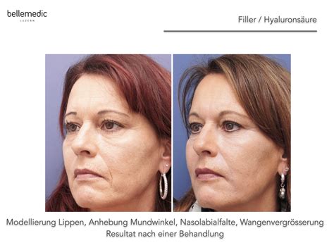Filler (Hyaluronsäure), Lippenvergrösserung, Faltenbehandlung