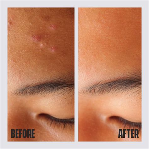 Acne Spot Gel - Best Pimple Remover - Dari Mooch