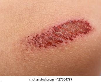 Infection Abrasion Skin Photos and Images & Pictures | Shutterstock