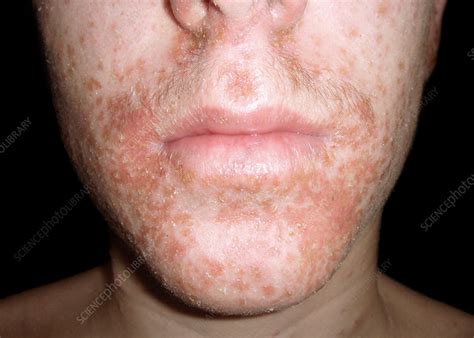 Impetigo on the face - Stock Image - C026/7551 - Science Photo Library