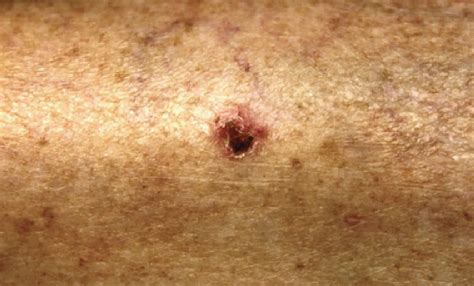 Crust Skin