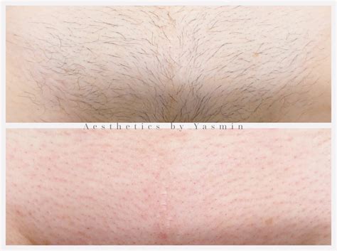 Pictures Of Brazilian Bikini Wax Before And After