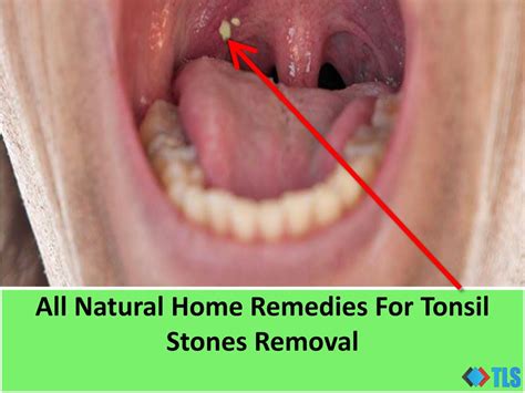 White Spots On Tonsils Stones