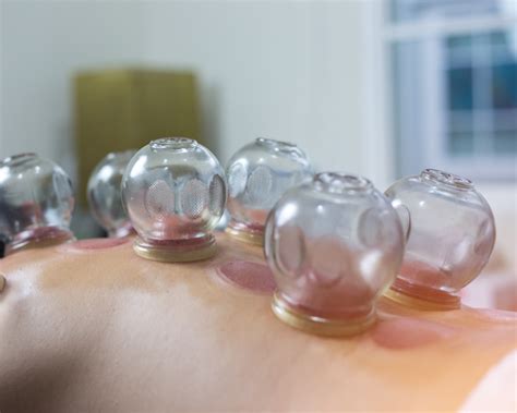 cupping massage therapy  whitstable healing health journey