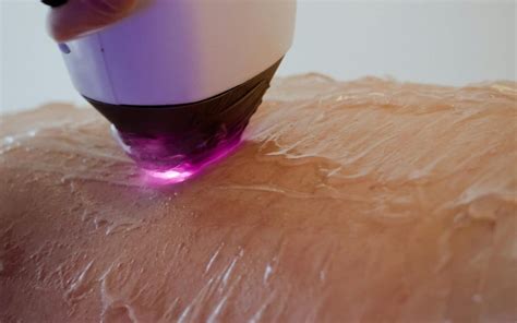 IPL Laser Hair Removal in Bournemouth - Laser Skin Solutions