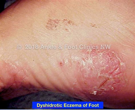 Dyshidrotic Eczema | Integrative Foot & Ankle Centers of Washington