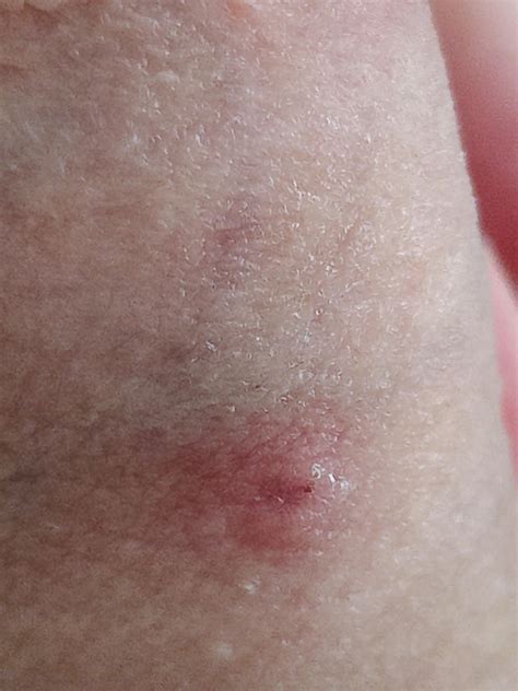 Is this a burrow or just some skin inflammation? : r/scabies