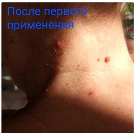 Лосьон Бороксил