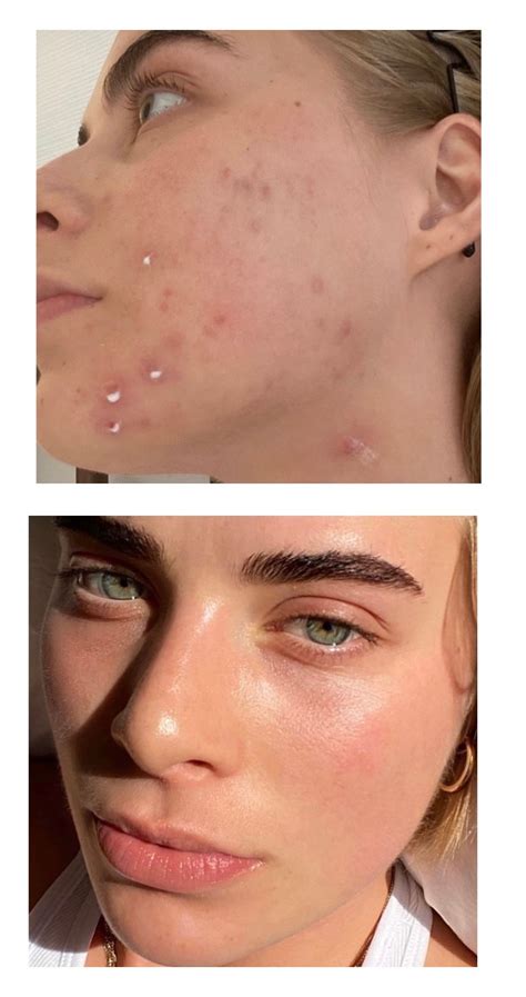 The Acne Solution Program | Holistico