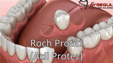 Acil Protez | Hızlı Protez | Roch Protez - YouTube