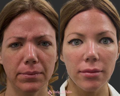 Nicole Kidman's Face: The Before & After Photos You Need To See NOW Image 3
