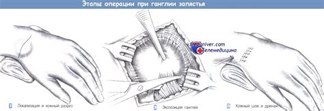 Этапы и техника операции при ганглии запястья