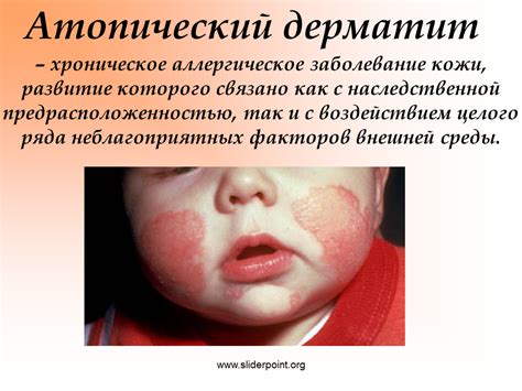 Аллергия - Презентация Медицина