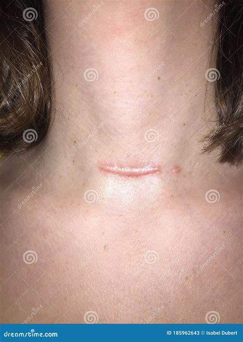 Raised Scar. Scar After Appendectomy. Cyanotic Keloid Scar Caused By