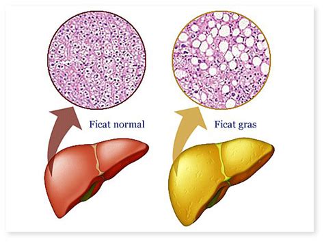 Steatoza hepatica | Medicina informativa