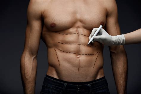 Lipo HD masculina: indicações, cuidados e benefícios - Dr. Edgar Lopez