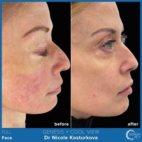 Розацея - причини, диагностика и лечение | Derma-Act