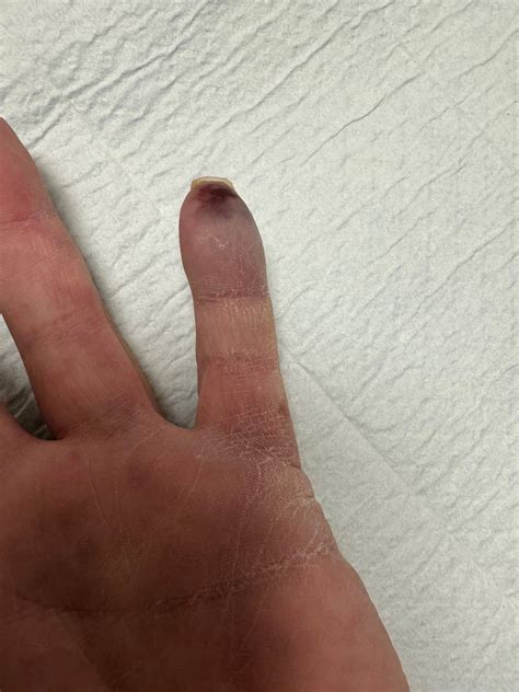 OrthoDx: Raynaud Disease - Clinical Advisor