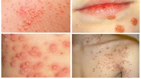 skin  soft tissue infection paediatric