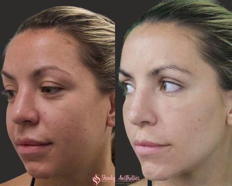 Chin Fillers - Before & After Results at Skinly