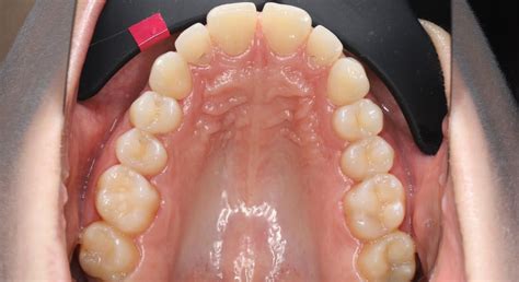 diastema correction  invisalign aligners sases   polar bear