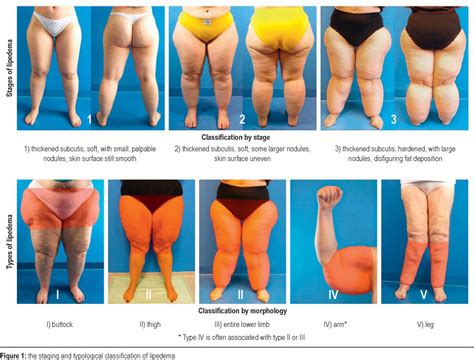 Lipedema Treatment | atelier-yuwa.ciao.jp