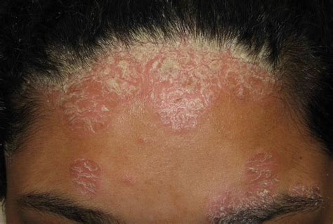 Extreme Rash In Adults : 30 Common Skin Rashes: Pictures, Symptoms, and