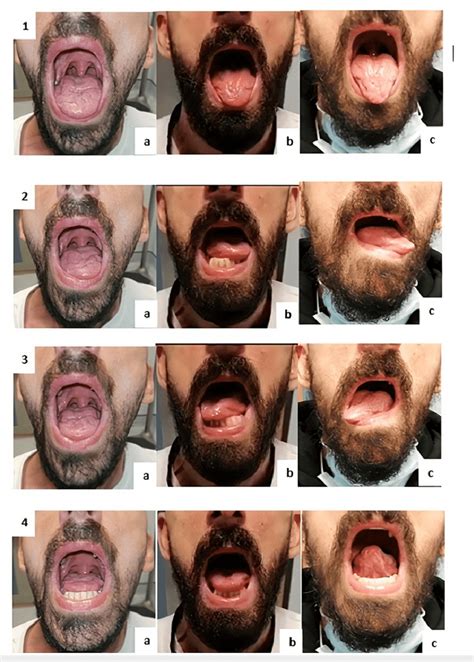 Evolution of tongue mobility during the rehabilitation program ...