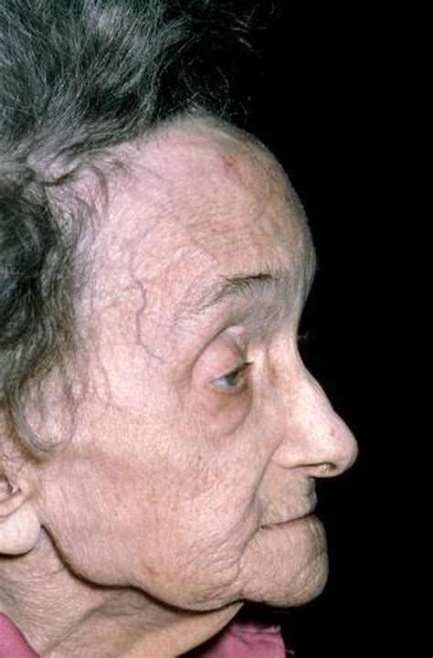 paget disease  bone musculoskeletal  connective tissue disorders