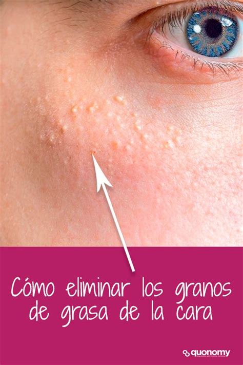 como eliminar los granos de grasa de la  quistes de milium como