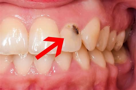 What Does a Cavity Look Like at Every Stage? (with Pictures)