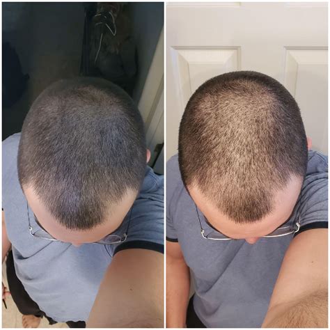 Finasteride side effects : r/HairlossResearch