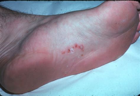 Gross Skin Diseases