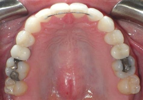 how much are retainers to replace