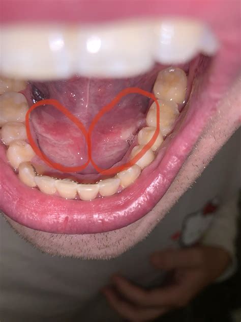 Hey canker sore experts, got these beauties under my tongue, they’re