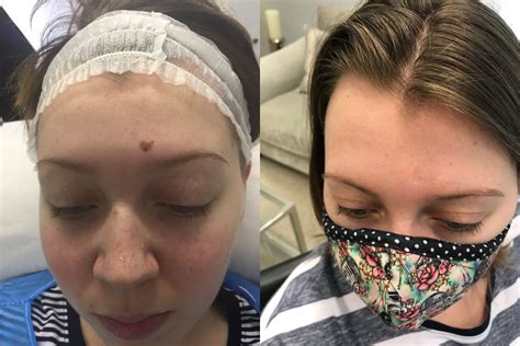 Mole On Face Removed