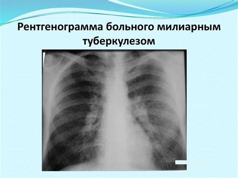 Диссеминированный туберкулез легких - презентация онлайн