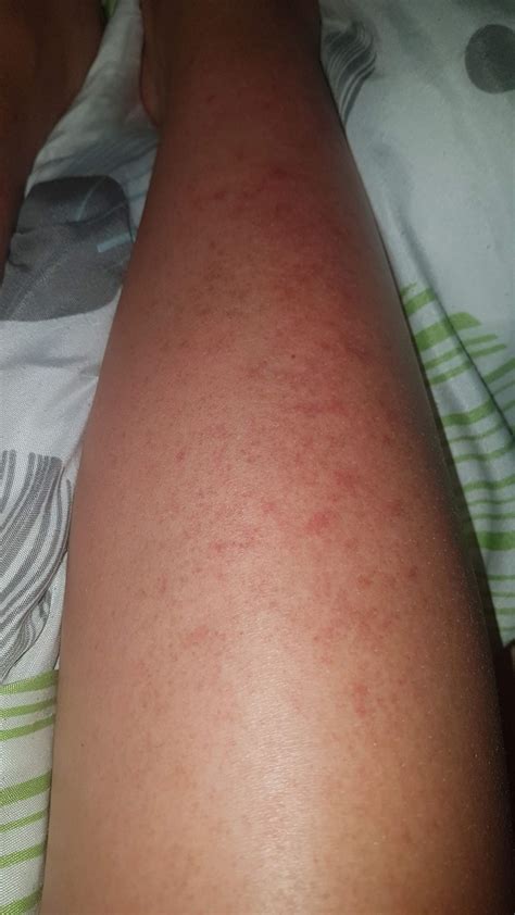 Was ist das für ein Ausschlag nach der Sonne? (Gesundheit und Medizin