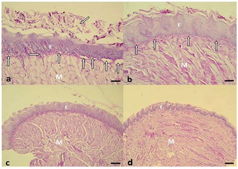 Oral Candidiasis Histology