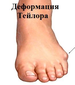 для чего нужен мизинец на ноге
