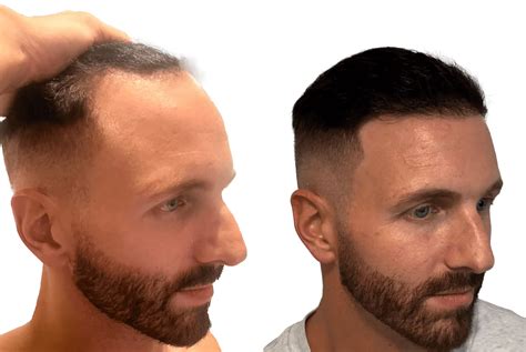 hair transplant grafts    find   ksl clinic