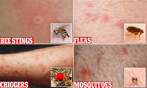 Flea Bites Vs Mosquito Bites