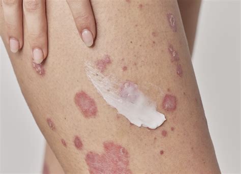 horrifying reality  topical steroid withdrawal