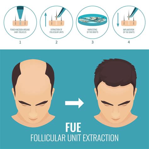 fue hair transplant  turkish hair