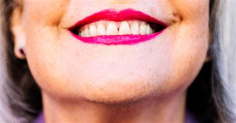 flexible partial denture  upper front teeth   choice