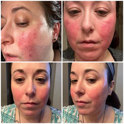 Rosacea Sciton Before And After Sciton Before and After | Northeast